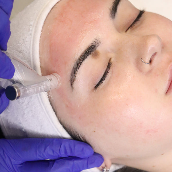3x Microneedling