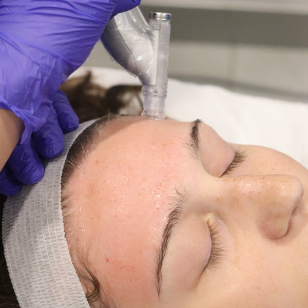Microneedling