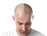 Scalp Micropigmentation Dollars