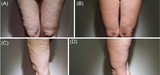 Hyperdilute Radiesse