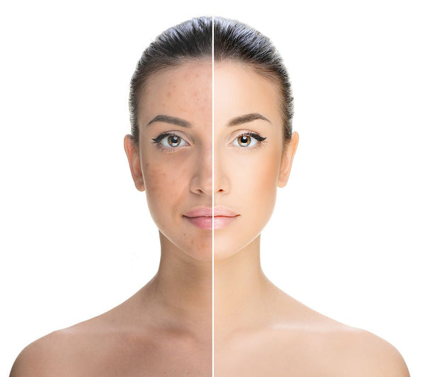 Photo Genesis (Photo facials + laser genesis) <br><h4><b>30% OFF</b>